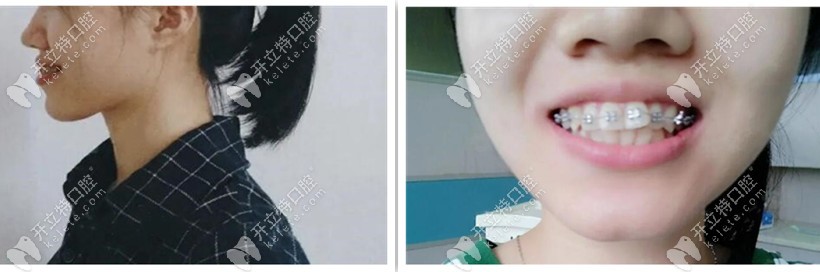 牙套兩個月側(cè)臉，嘴還是突