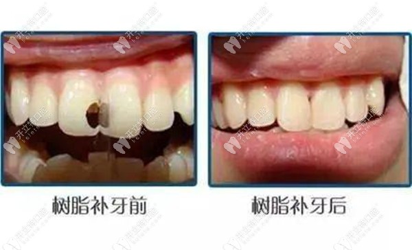 樹脂補(bǔ)牙前后效果對(duì)比