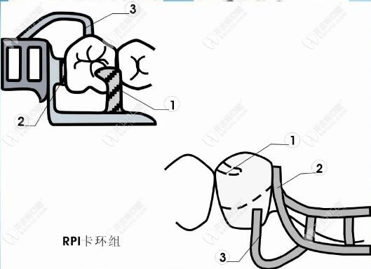 RPI卡環(huán)組