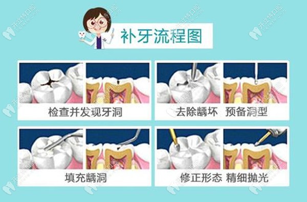 補(bǔ)牙過程圖解