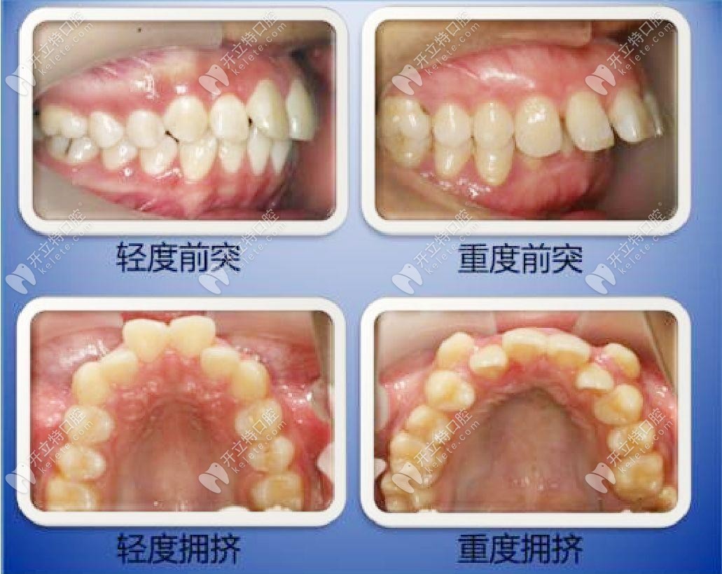 什么情況下需要拔牙才能矯正牙齒？