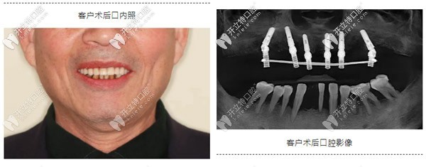典型重度牙周炎種植案例:如何實(shí)現(xiàn)即刻種植與即刻修復(fù)？