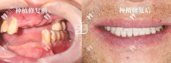 數(shù)字化種牙進(jìn)行中：采用諾貝爾allon6+4全口負(fù)重技術(shù)