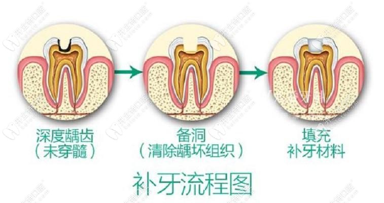 補(bǔ)牙流程圖