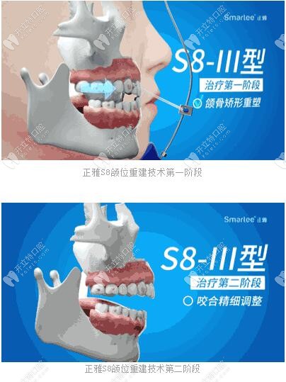 正雅S8、S9、S10頜位重建術