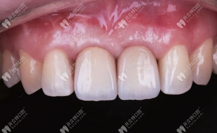整個修復(fù)病例完成后的情況